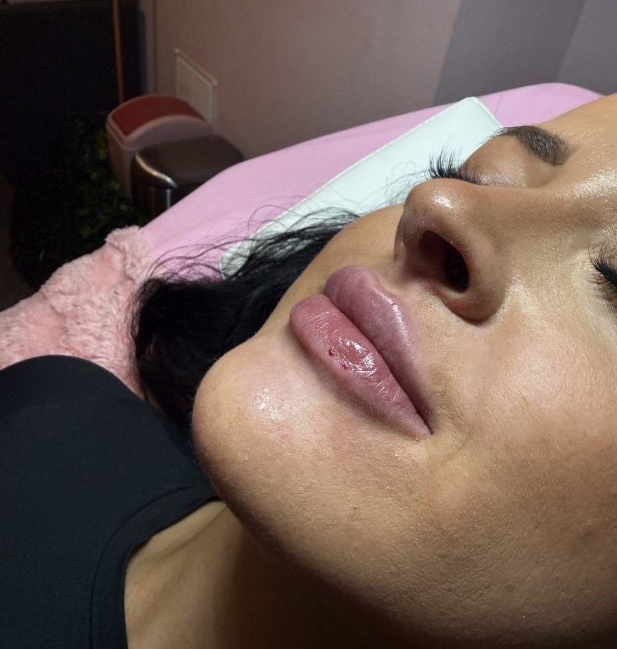 Aesthetics treatment