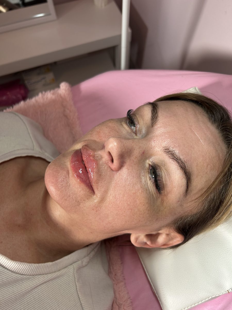 Aesthetics treatment