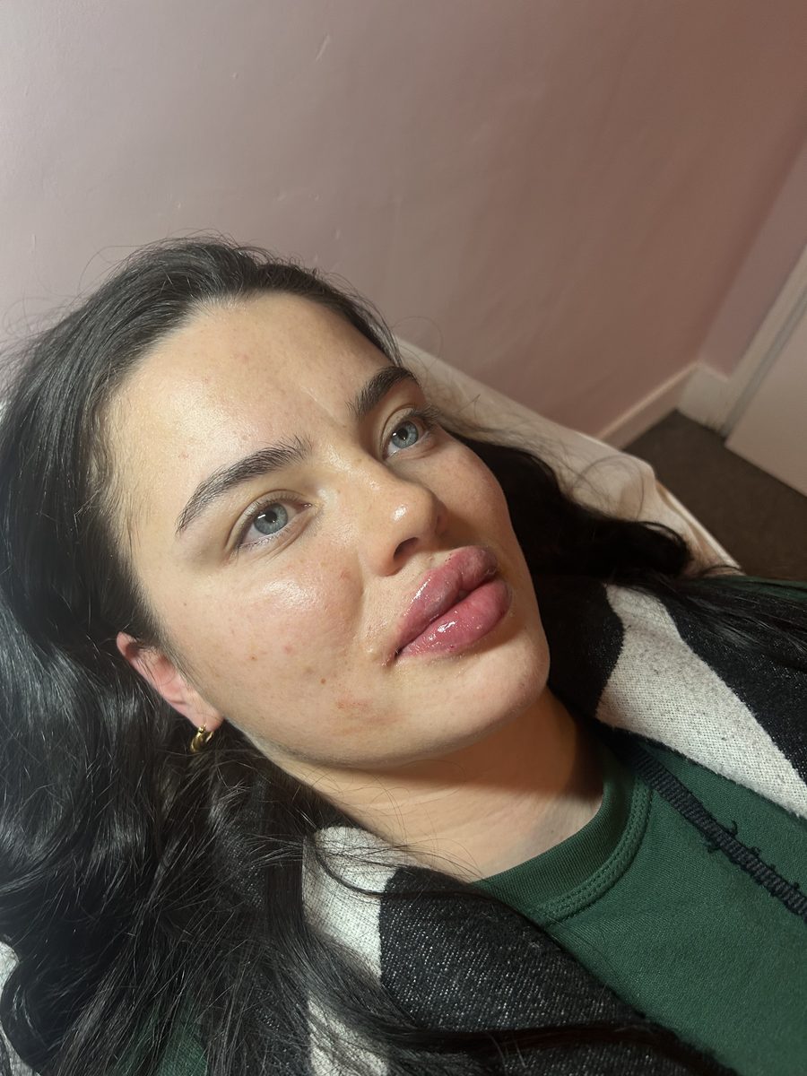 Aesthetics treatment